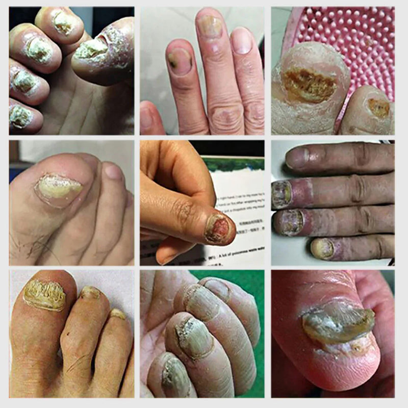 Suai Repair -  Elimina fungos e restaura unhas danificadas